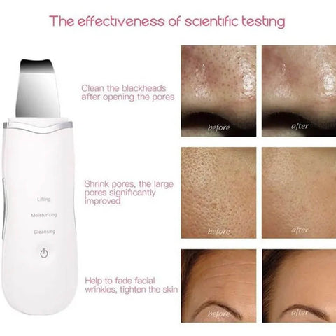 Ultrasonic Facial Skin Scrubber
